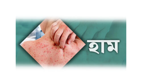 সিলেটে হামের পরিস্থিতি উদ্বেগজনক, একদিনে হাসপাতালে ভর্তি ২০১