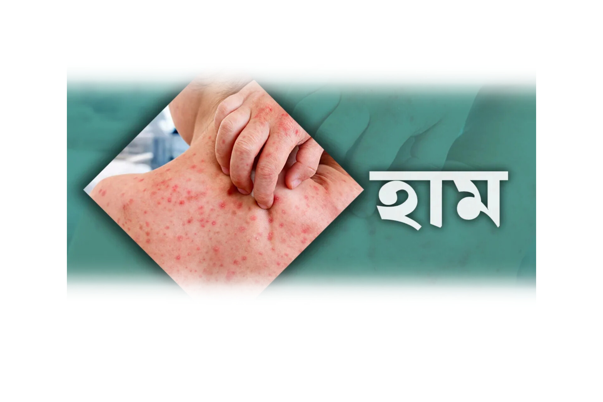 সিলেটে হামের পরিস্থিতি উদ্বেগজনক, একদিনে হাসপাতালে ভর্তি ২০১