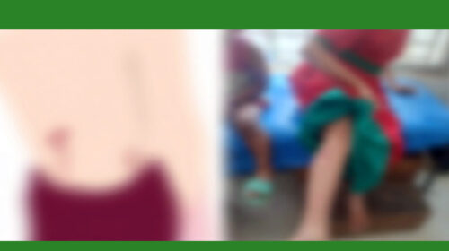 পাগলা কুকুরের কামড়ে শিশু ও স্কুল ছাত্রীসহ অন্তত ৫০ জন আহত