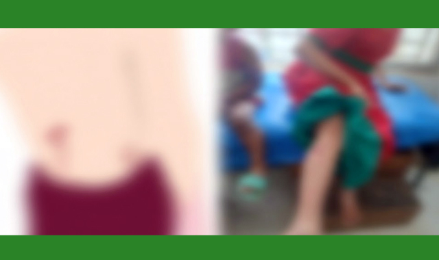 পাগলা কুকুরের কামড়ে শিশু ও স্কুল ছাত্রীসহ অন্তত ৫০ জন আহত